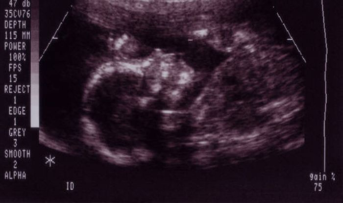 Ultrasound image