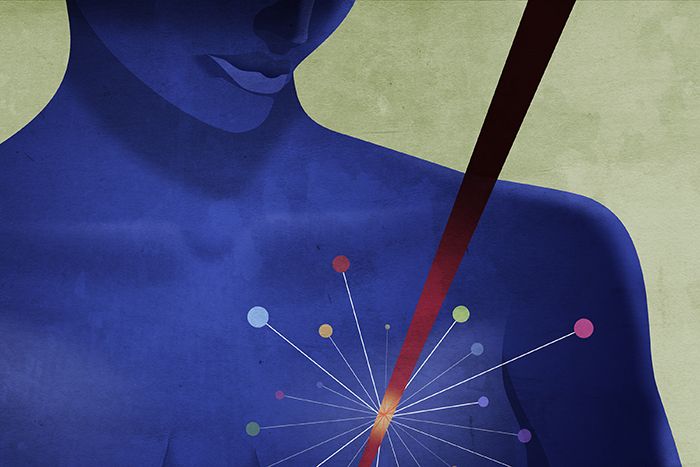 breast cancer illustration
