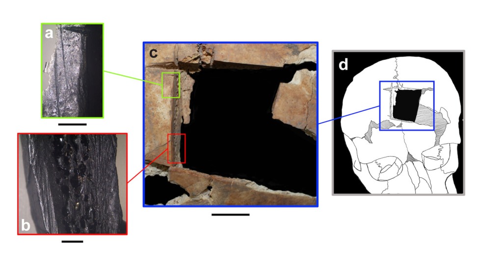 "Brown Ph.D. student uncovers early evidence of brain surgery in Ancient Near East; Not long before one of the brothers died, he had undergone a specific type of cranial surgery called angular notched trephination. The procedure involves cutting the scalp, using an instrument with a sharp beveled edge to carve four intersecting lines in the skull, and using leverage to make a square-shaped hole."