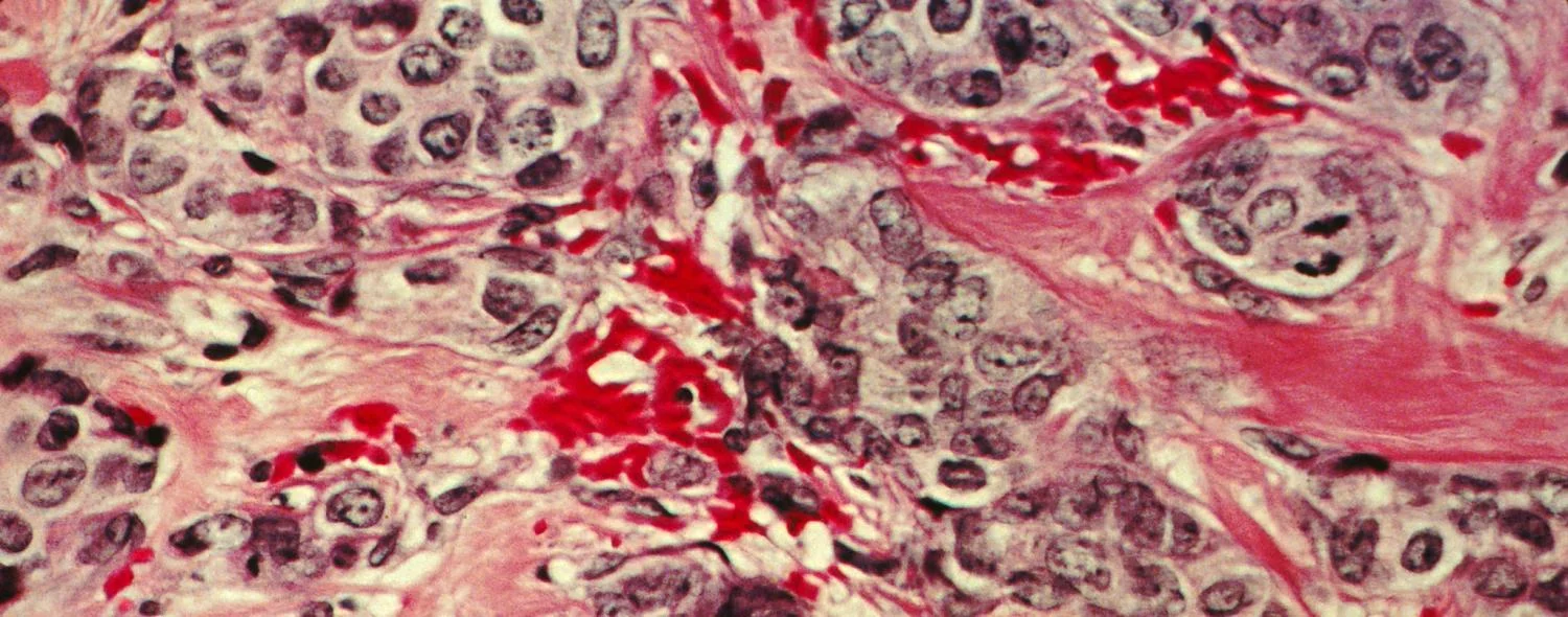 Researchers identify promising new target for drug-resistant breast and ovarian cancers; Breast cancer cells under the microscope. Credit: NIH