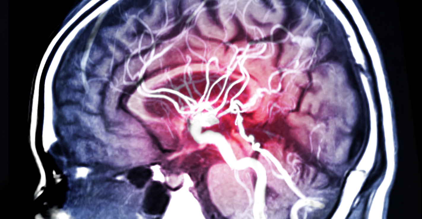 Yale researchers find early developmental gene can cause deadly aneurysms