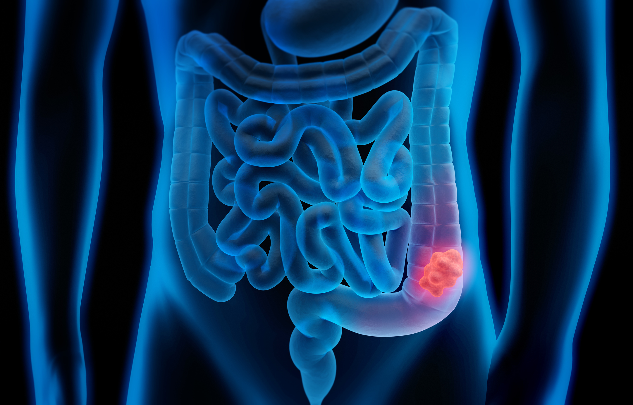 Why Are Colorectal Cancer Rates Rising Among Younger Adults?; Pictured is a 3d illustration of colon cancer
