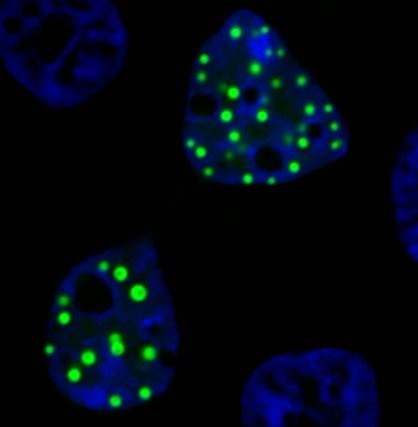 oncofusion protein FUS-DDIT3 forming ectopic droplets inside laboratory-cultured live cells
