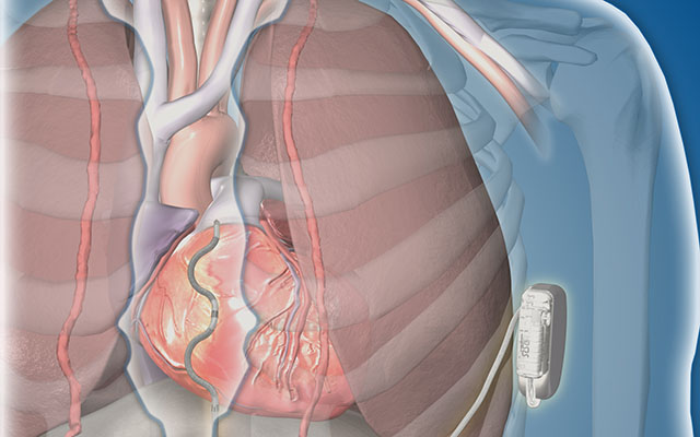 investigational ICD device