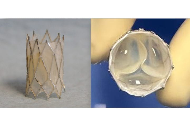 The Iris Valve, a transcatheter, growth-accommodating pulmonary valve designed for very young children