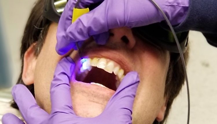 dentist working on teeth with cavities