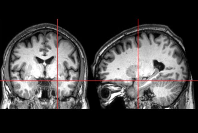 MRI of an infant's brain, amygdala