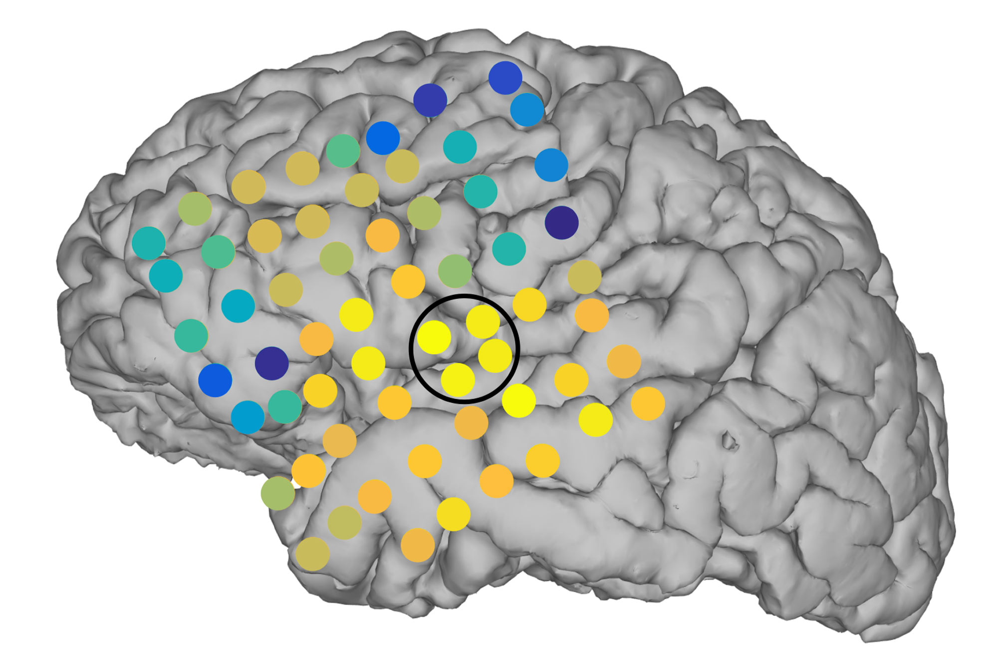 eeg of normal brain vs epilepsy eeg of normal brain vs epilepsy