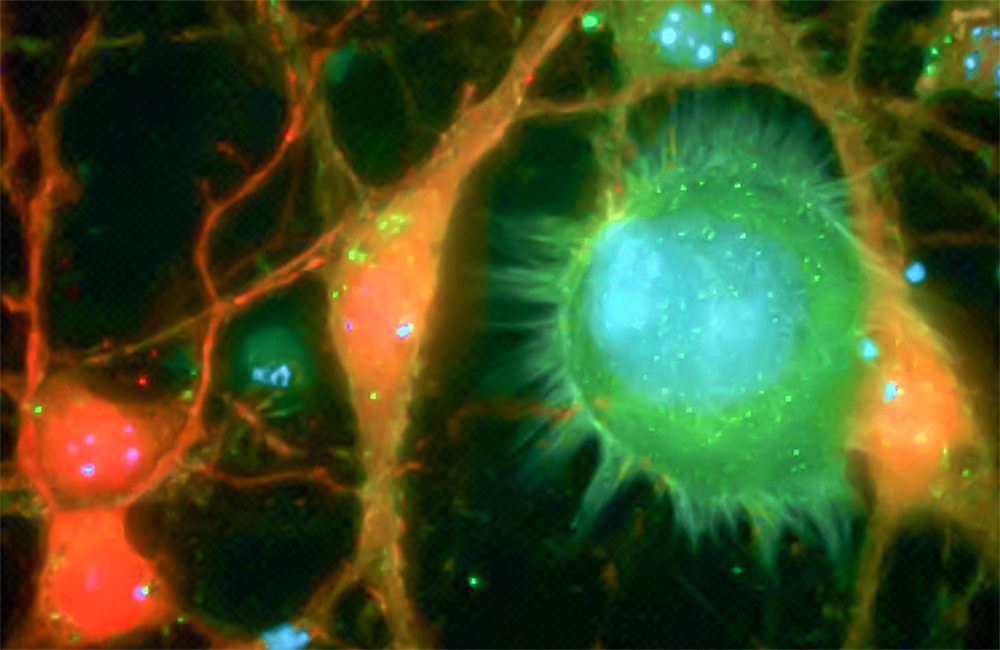 Metastatic breast cancer cells imaged