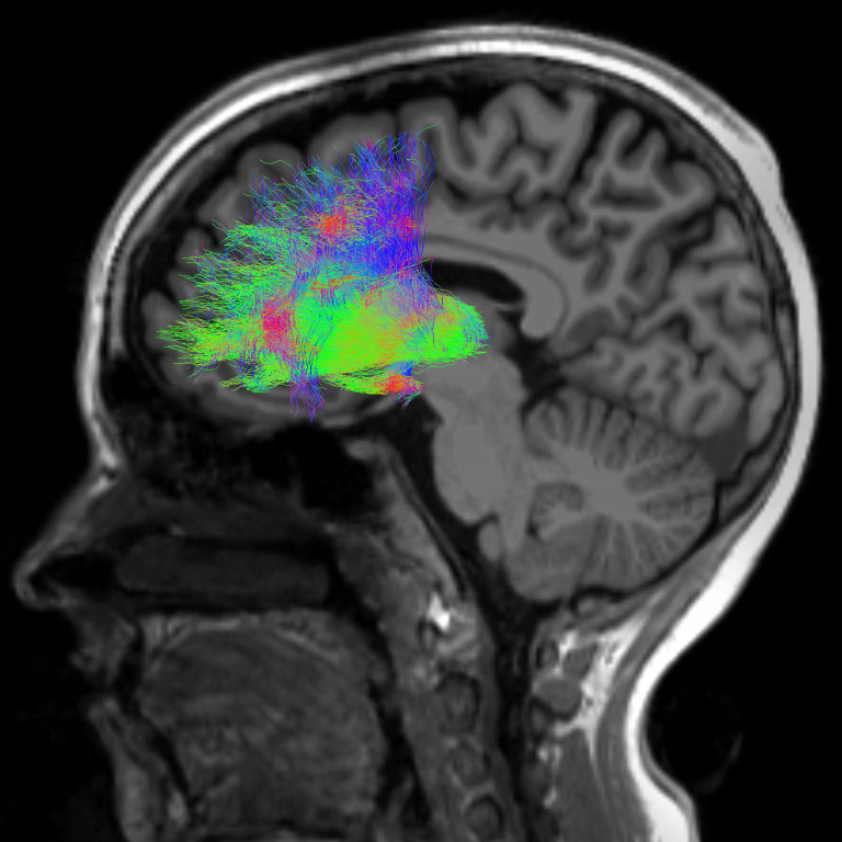 Imaging of the connections between the mediodorsal thalamus and prefrontal cortex in the human brain. Photo: Mengzing Liu / Tufts University