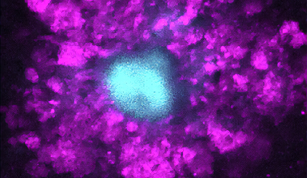 Swelling caused by amyloid plaques in the brain may be the root of Alzheimer's debilitating symptoms, Yale researchers have found.
