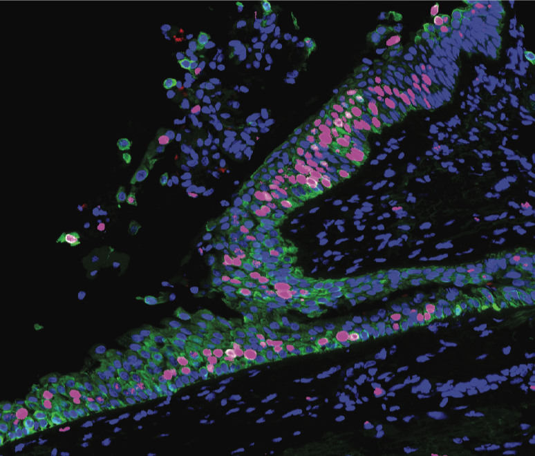Amicroscopic image of precancerous lung tissue.