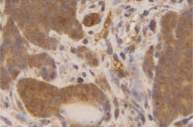 lesions
