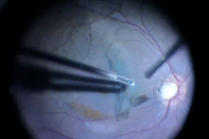 During a retinal surgery, Rajendra Apte, MD, PhD, removes blood from a hemorrhage that had interfered with the patient's vision.