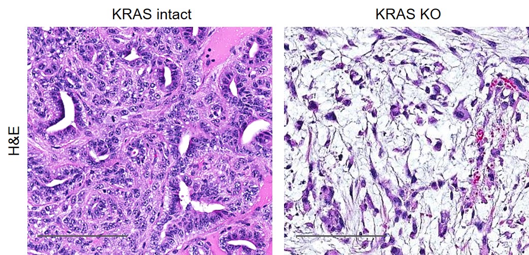 Images showing KRAS intact in tumor tissue and knocked out in a laboratory model of PDAC.