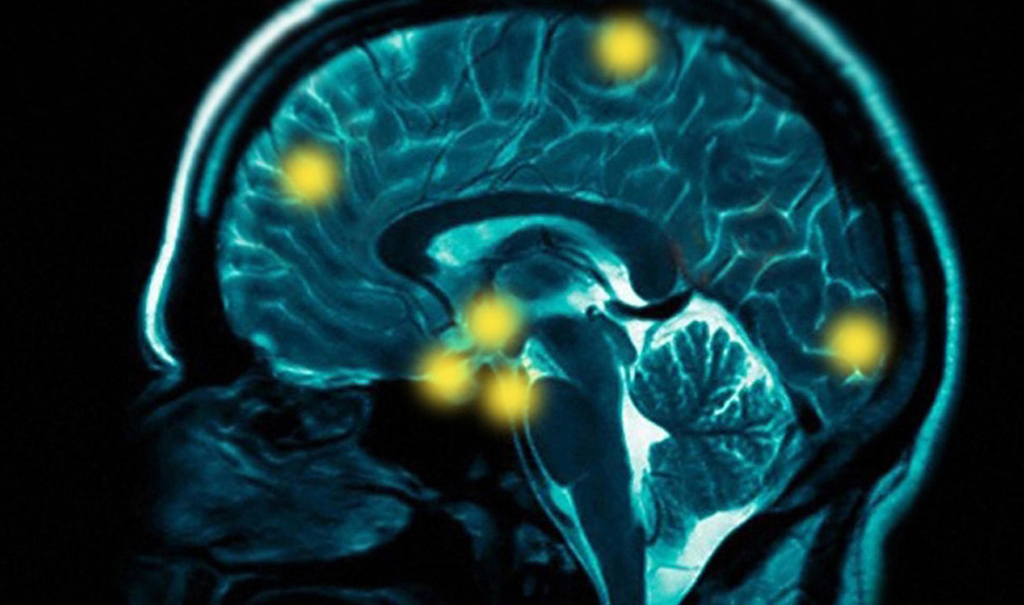 A scan of a brain.