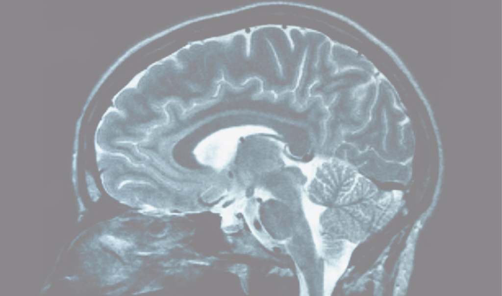 An MRI scan of a brain.