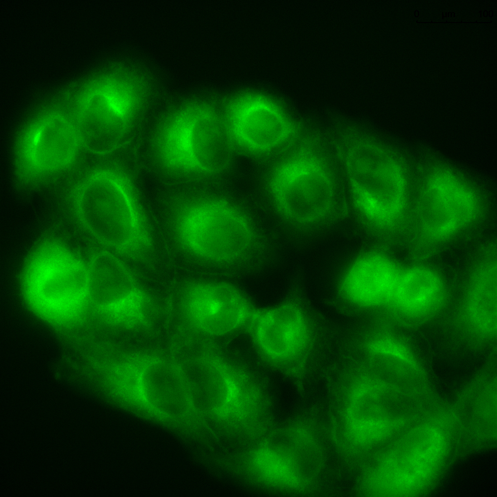 Cancer cells