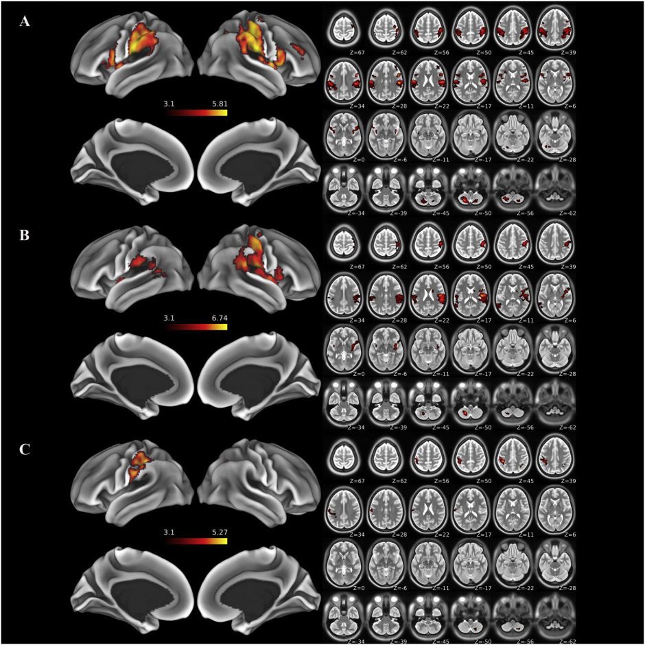 These are results of a functional MRI on the whole brain.