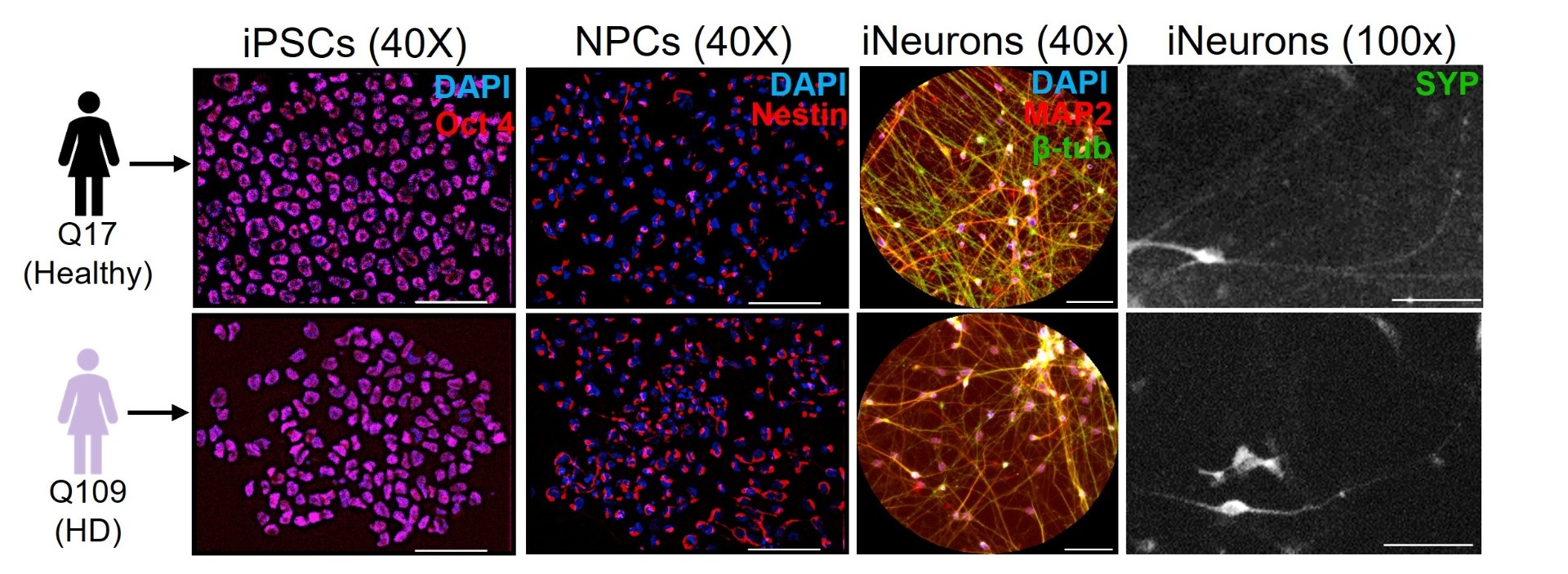 Magnified comparison between healthy neurons and neurons affected by Huntington's Disease