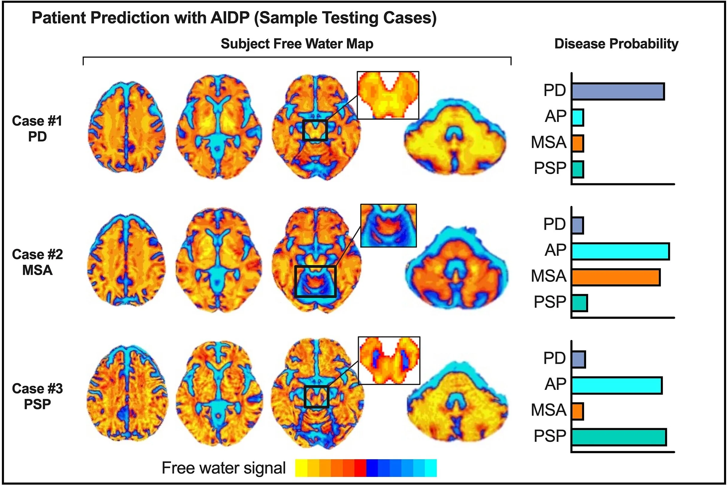 Graphic showing brain scans and patient prediction of Parkinsons Disease