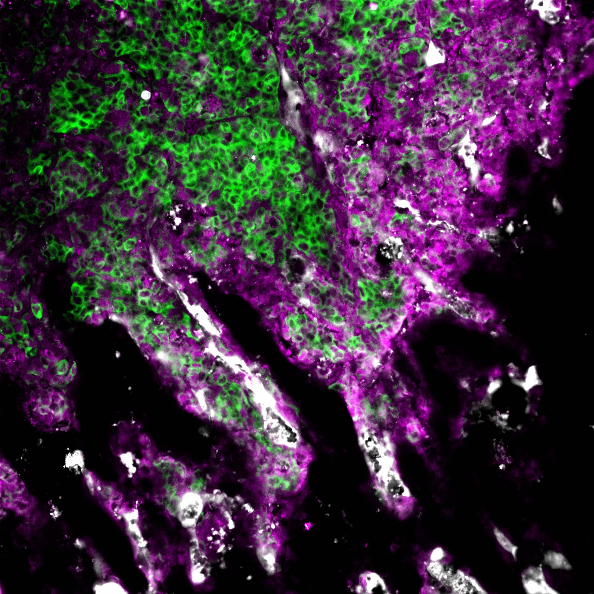 Microscopic image of breast cancer cells invading bone cells.