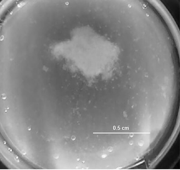 A breast macrotumor of invasive ductal carcinoma type embedded in gel