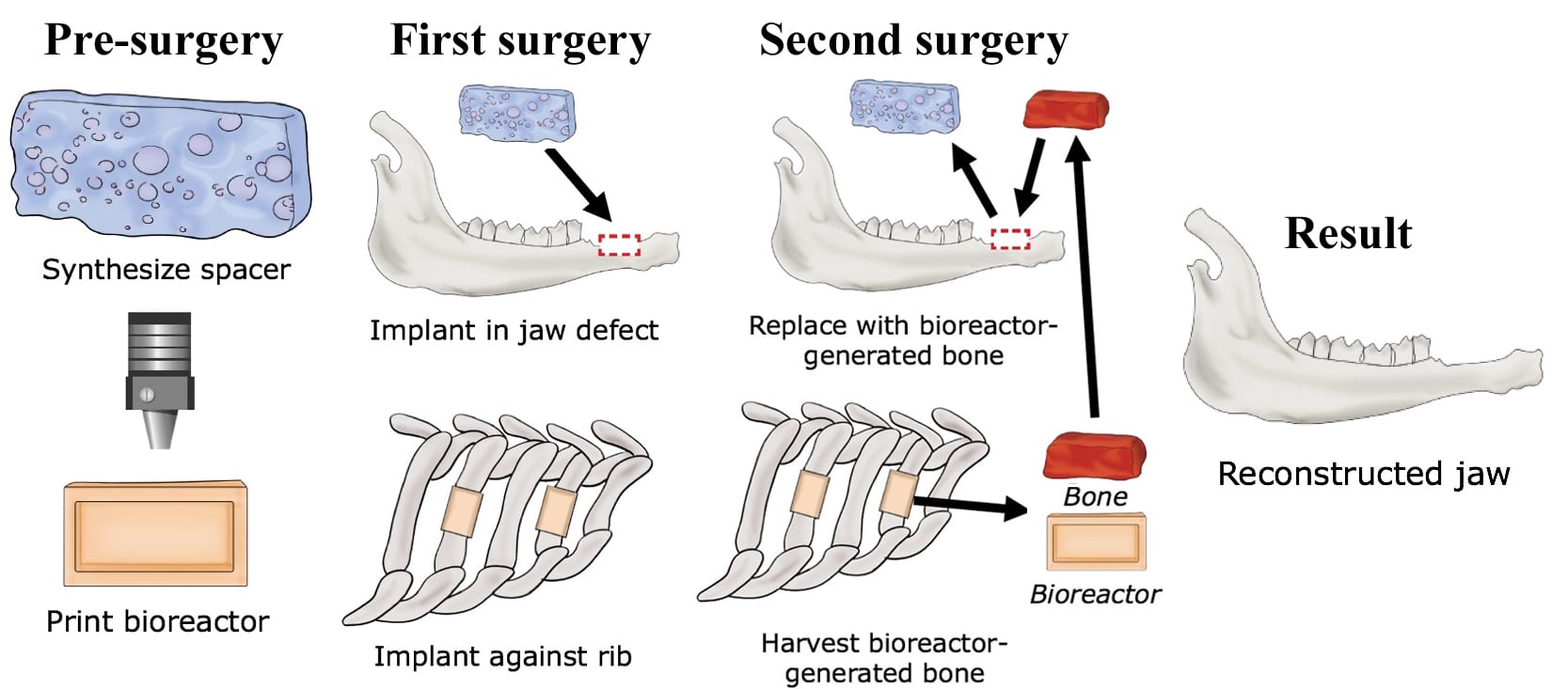 How to grow a jawbone.