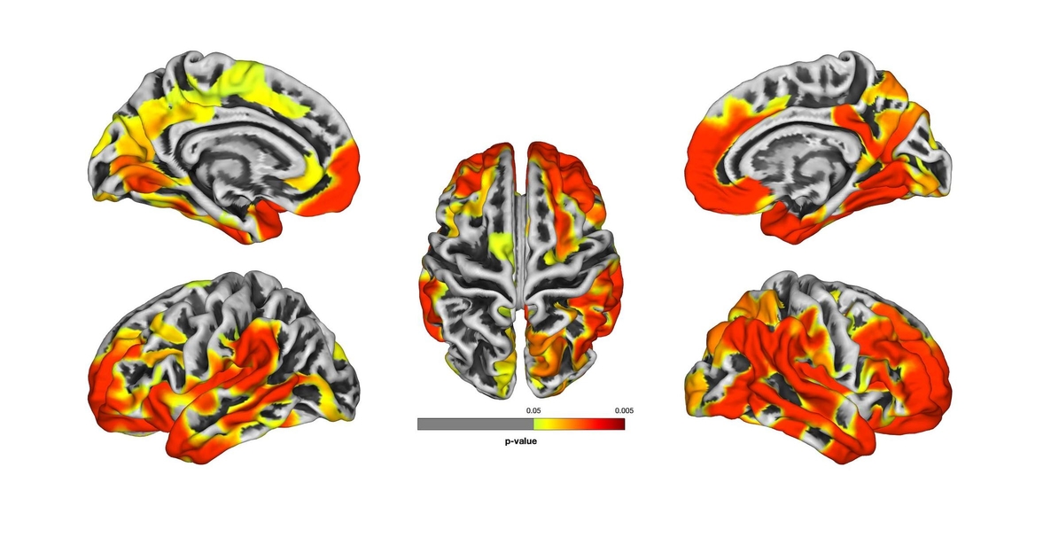 Brain image