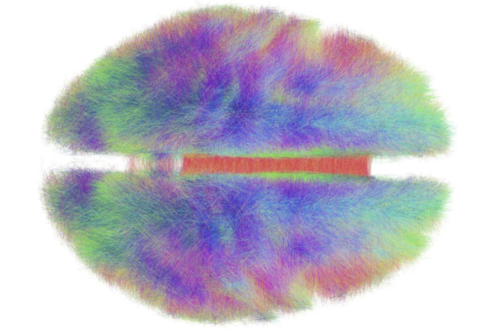 A Concussed Brain.