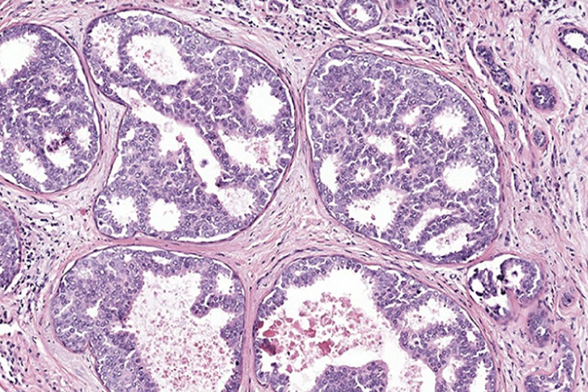 Image of ductal carcinoma in situ. 
