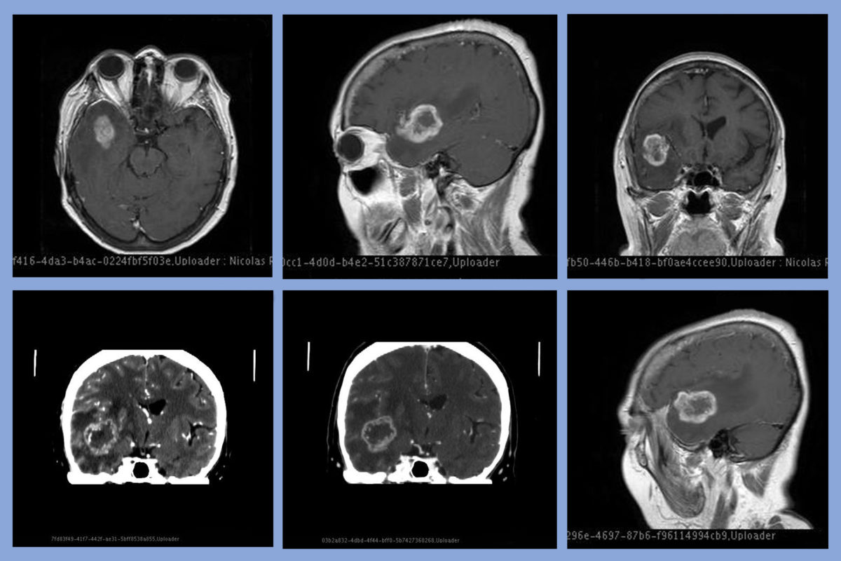 A brain scan of a glioblastoma tumor.