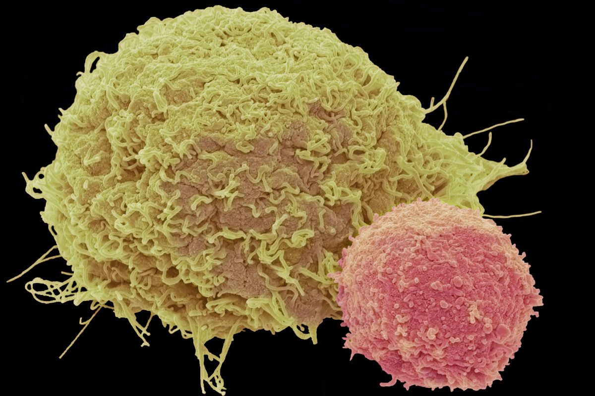 A red t-cell attached to a cancer cell.
