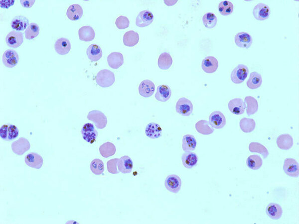 Second gene implicated in malaria parasite resistance evolution to chloroquine