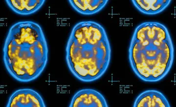 Brain Pet scan