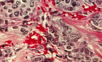 Researchers identify promising new target for drug-resistant breast and ovarian cancers;  Breast cancer cells under the microscope. Credit: NIH