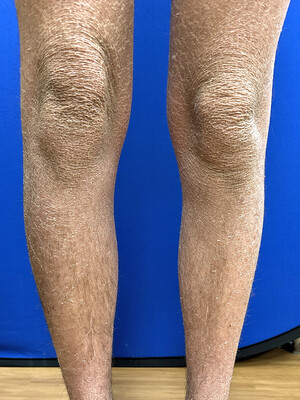 "Yale tests a treatment for skin diseases that often target children; Congenital ichthyosis is a group of skin diseases characterized by dry, scaly patches that cover the body."