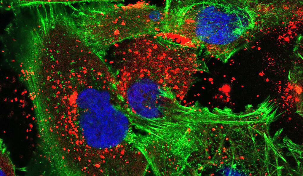 New treatment merges two technologies to fight brain cancer; In this image, the nanoparticles (red) are visible within human glioma tumor cells (green with blue nuclei).
